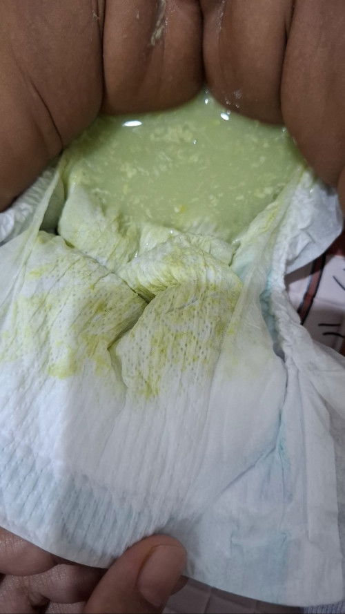 Bunda, aku punya bayi usia 2 bulan, eeknya warna hijau cair... ada yang pernah begini juga engga ?