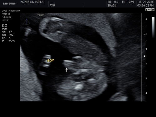 its a boy?