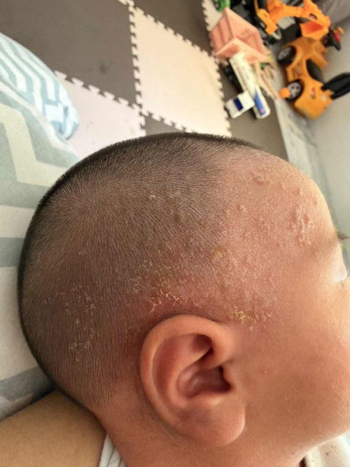 Salam mommies, ada tak yang ada pengalaman utk hilangkan biji bji putih dkt kepala baby?
