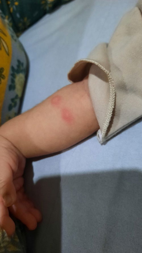 ruam merah pada newborn