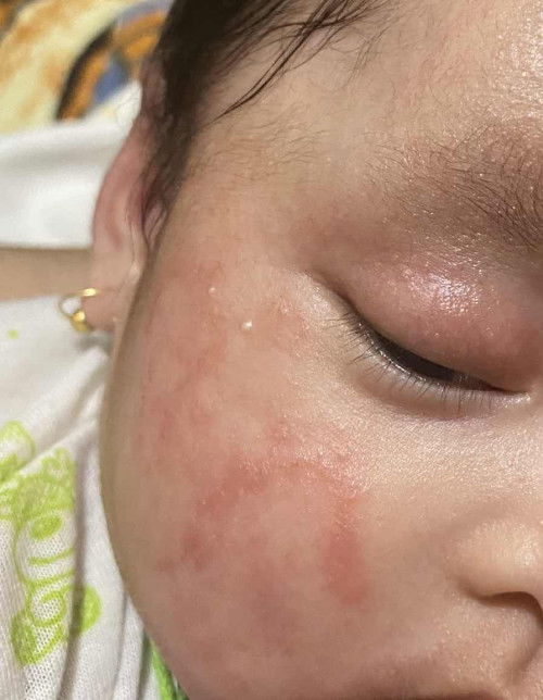 eksim atau dermatitis