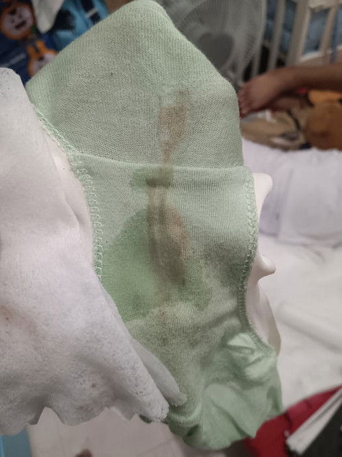 Brown discharge