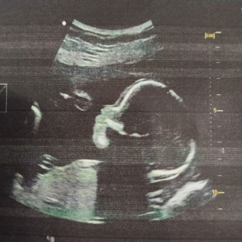 Ano pong mangyayari pag nalaglag ka sa hagdan 5months preggy?