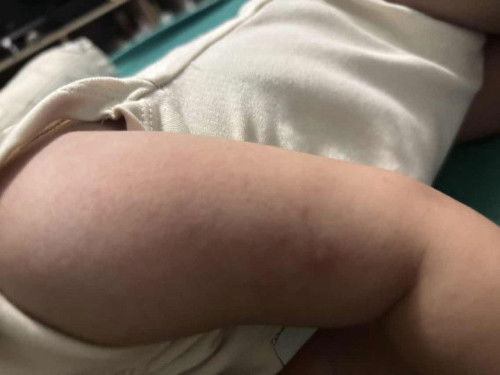 Alergi atau biang keringat