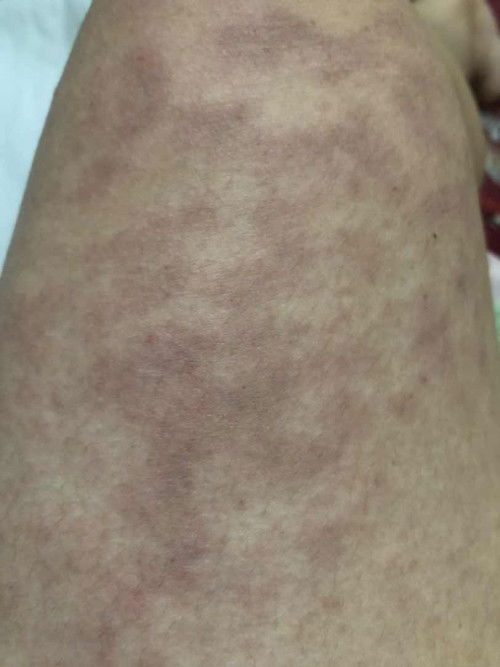 Gatal awal kehamilan