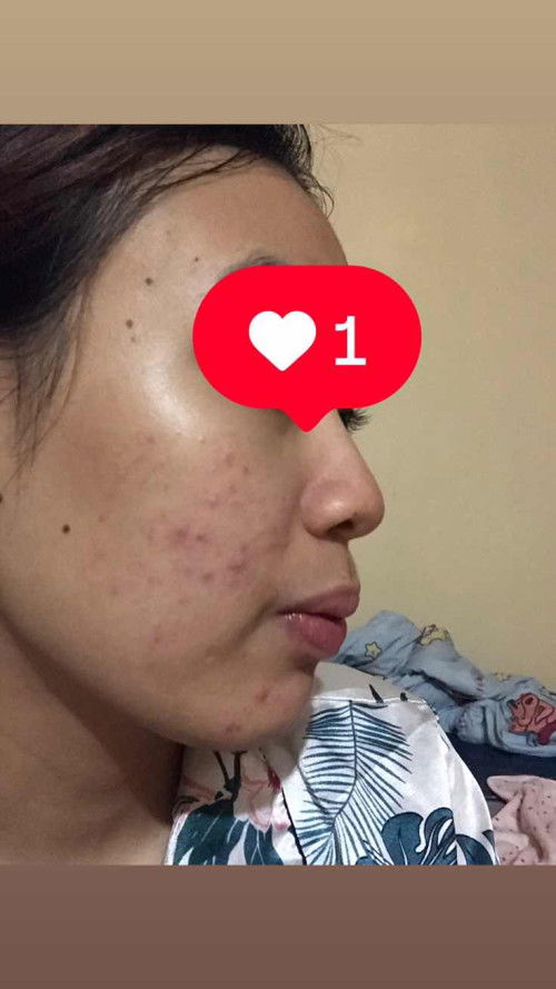 สอบถามแม่ๆทุกท่านหน่อยค่ะ มีแม่ๆบ้านไหนเป็นสิวหนักๆแบบเรามั้ยคะ แล้วคลอดน้องแล้วมันหายไปมั้ย 12+6 วีค ค่ะ