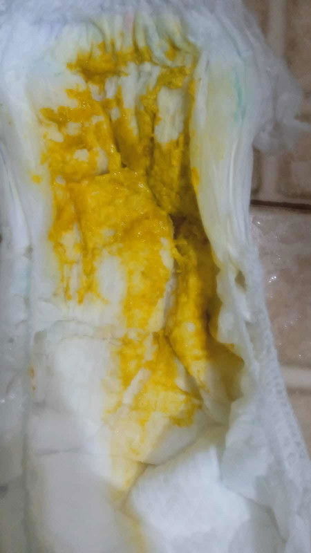Diare anak Mpasi (6 Bulan)