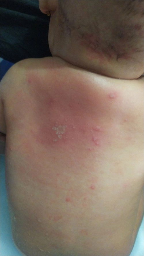 Punggung bayi merah knapa yaa