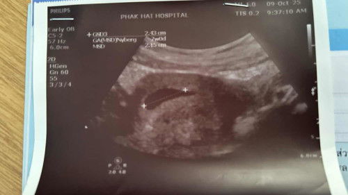 7สัปดาห์แล้วยังไม่พบตัว มีใครเป็นบ้างค่ะ