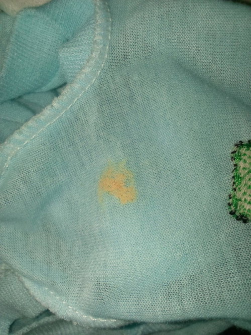 Pipis bayi di sertai noda kuning, dan bekas ruam popok