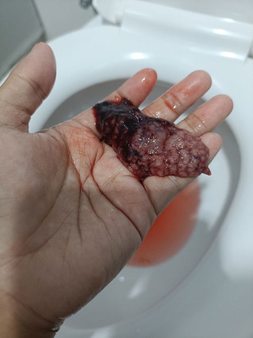 มีลิ่มเลือดลักษณะแบบนี้ออกมา
