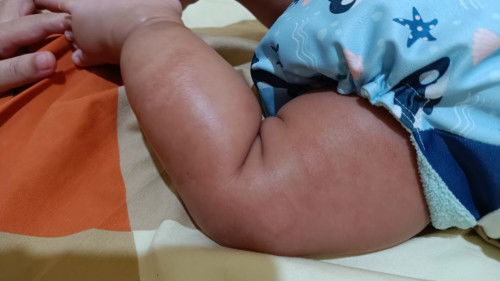 Cara nyembuhin kulit merah