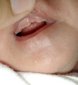 mga mhie normal lang ba ganto Ang gums ng baby? ano po tawag sa ganyan?

#FTM