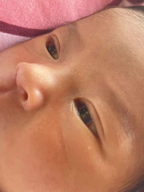 น้องพึ่งคลอดได้10วันมีตาแดงแบบนี้ปกติไหมคะ