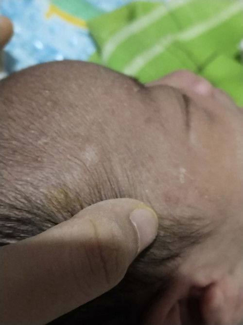 Benjolan kecil di dahi