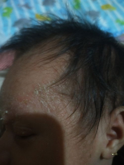 Iritasi bayi