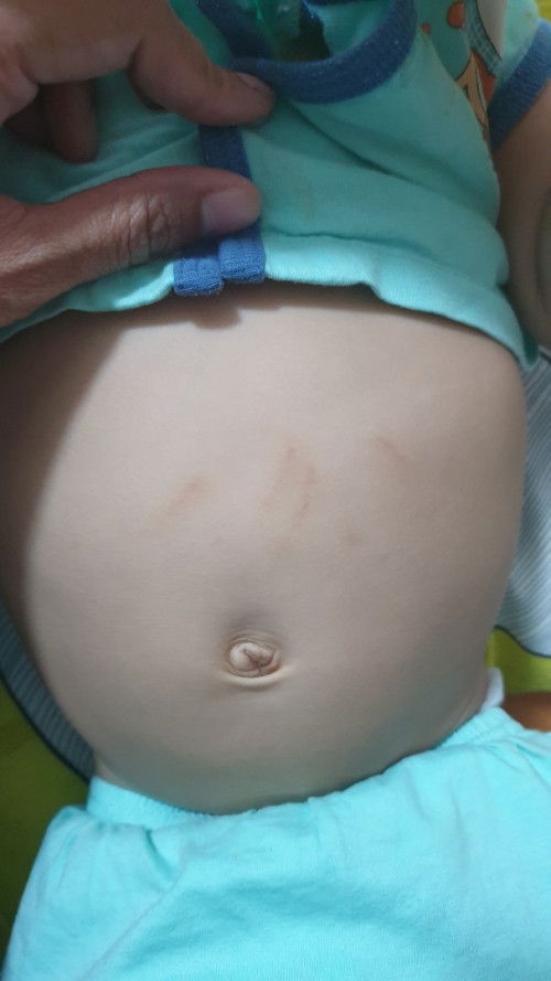 Kesan pada perut anak