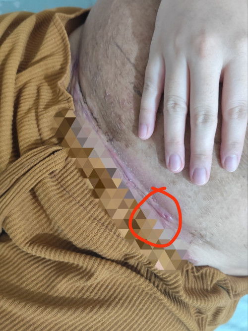 Mabahong tahi cs bikini type