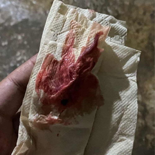 39+1 ปากมดลูกเปิด1เซน อยากสอบถามแม่ๆที่เคยมีประสบการณ์ อีกนานไหมคะกว่าจะเปิดเพิ่ม ท้องแรก เจ็บท้องทุก7-8นาที พอทนได้ค่ะ