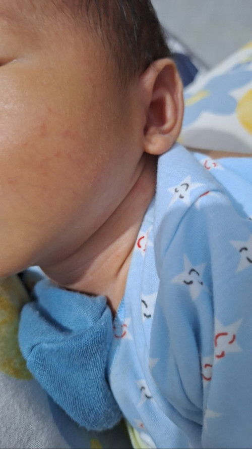 Baby 19 hari muka leher punggung bintik2 merah