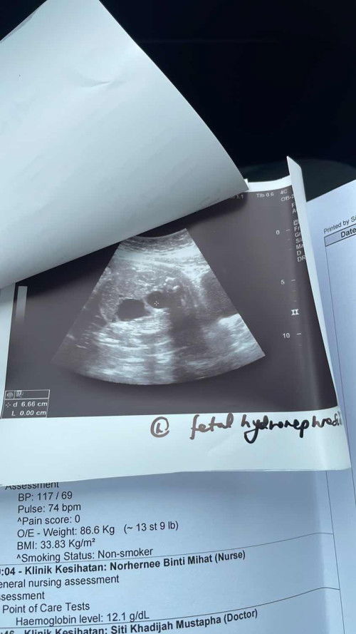 Severe Hydronephrosis