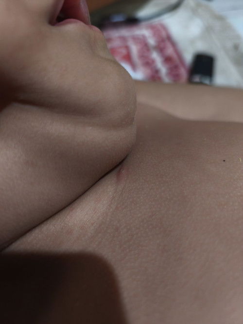 Bentol pada bayi 1 tahun 3 bulan