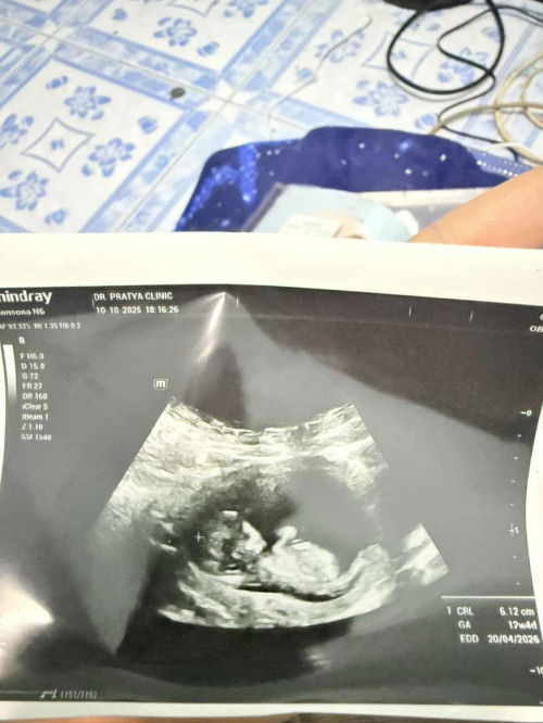 13 week มีเลือดออก