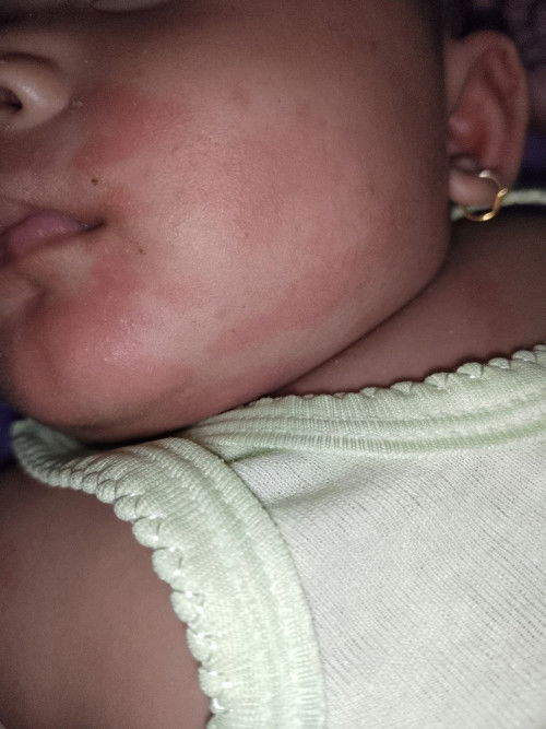 Merah merah pada badan bayi