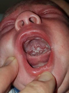 Oral thrush