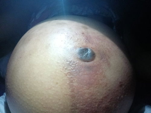 Mga Mii may nakaranas po ba nito sa Inyo? Maliliit na Butol na parang may tubig na sobrang Kati po.