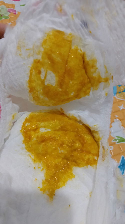 Diare pada bayi 2 bulan full asi
