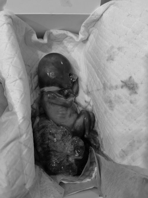 Nawalan ng heartbeat c Baby