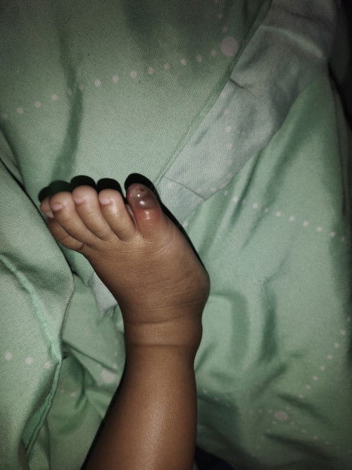 Jari kaki kelingking bengkak