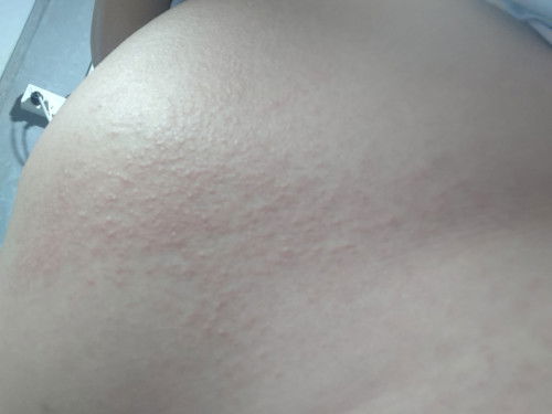 มีผื่นแดงคันที่ท้อง มีใครเคยเป็นแบบนี้ไม่คะ คุณหมอให้ยามาทากับกินแก้แพ้คะ กังวลกลัวเป็นอันตรายกับลูก