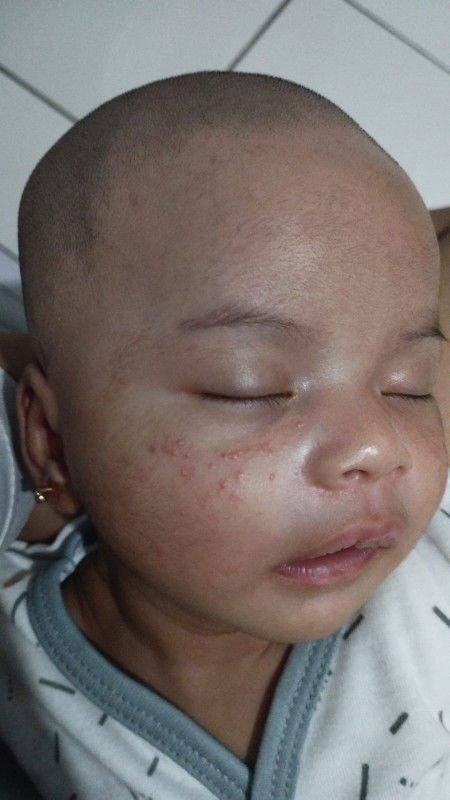 Bruntusan di pipi bayi 3minggu