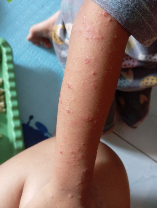 Gatal di badan anak.