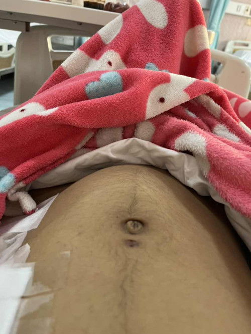 มดลูกรอยหรือลูกโก่งตัวคะ