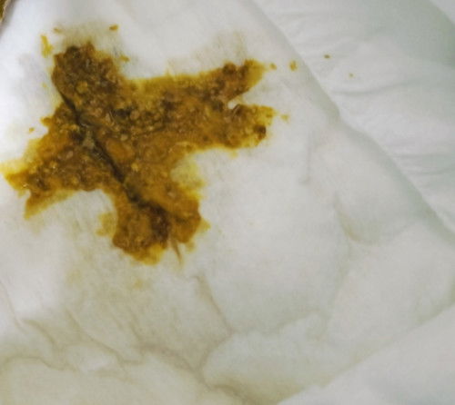 อึแบบนี้ปกติไหมคะ