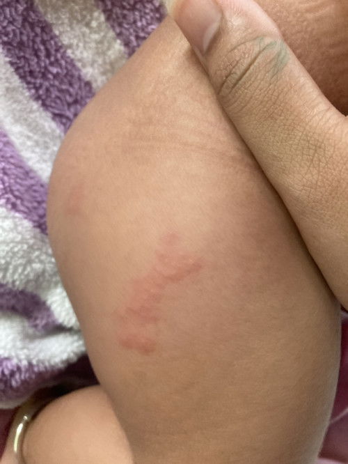 ขอสอบถามหน่อยคะเป็นผื่นของอะไรคะ