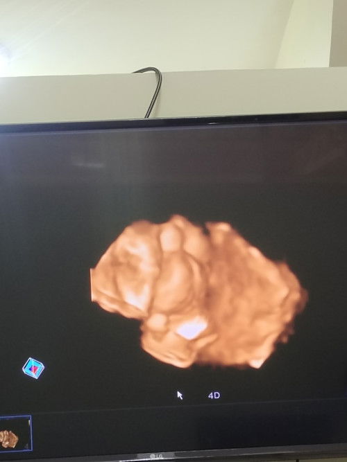 แม่ๆช่วยดูเพศหน่อยค่ะ ชายชัวร์มั้ยคะ ซาวด์ตอน35+2