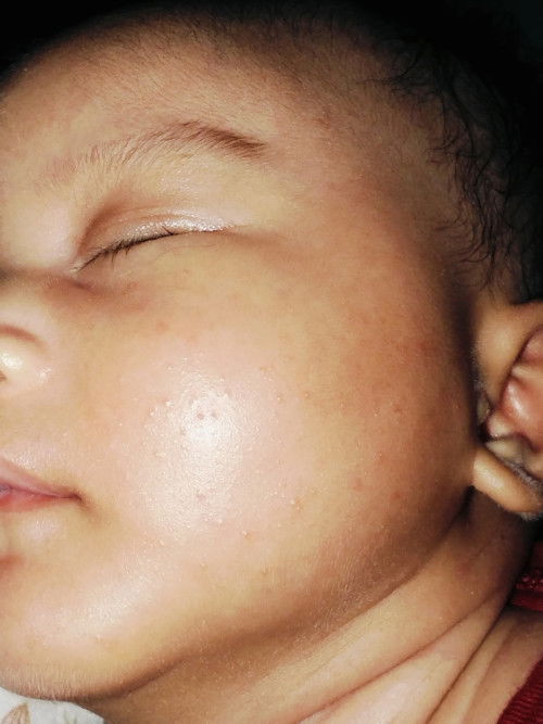 Bun, anakku di pipi bintik2 kecil gini blm pake apa2 tapi bintik2.Pilihan skincare apa ya? Makasih..