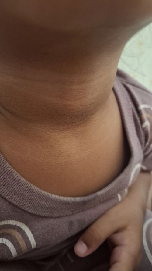Gatal di leher anak , dan bewarna gelap .