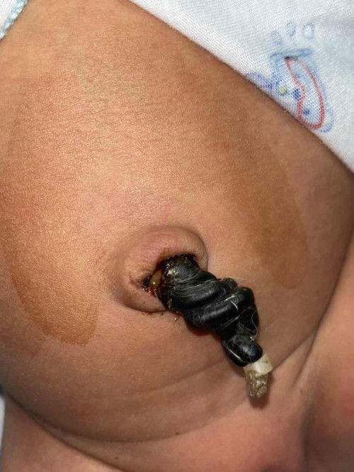 สะดือมีเหมือนหนองและเลือดออก