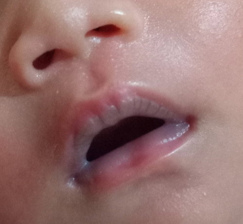 Bibir bayi seperti ini