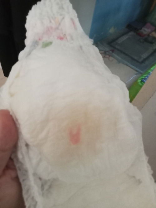 Tanda apa ini? Pada pipis bayi laki2 usia 6 bln 10 hari. Mohon pencerahannya