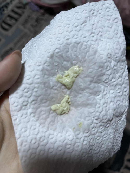 ท้อง7เดือน ตกขาวเป็นแบบนี้ข้างใน