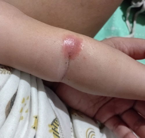 merah di lengan