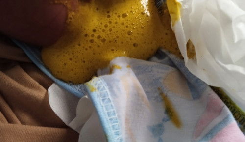 bunda" mau tanya. babyku usia 36hr, srng pup sprti ini. asi+sufor bebelv klw krg kenyang. wjr ga?