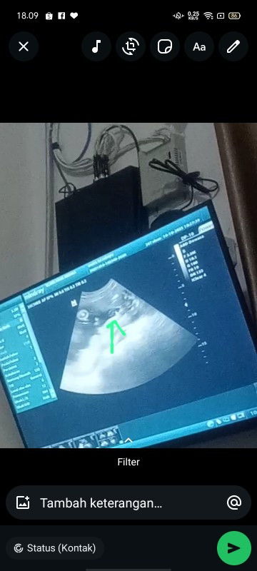 Hasil USG 25 week JK masih ragu