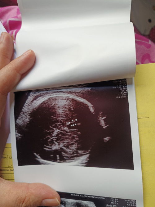 ผลอัลตร้าซาวด์